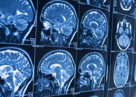 نشانه اصلی ابتلا به تومور مغزی چیست؟