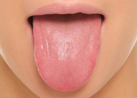تشخیص بیماری از روی رنگ زبان